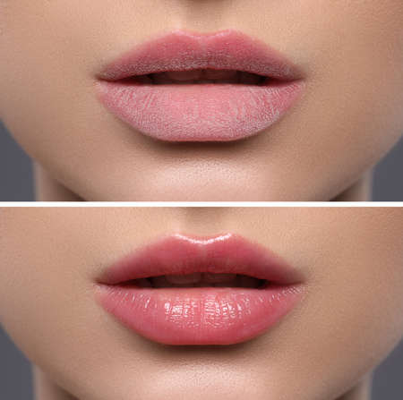 Collage with photos of woman with dry and moisturized lips, closeupの写真素材