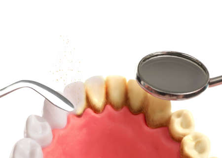 Examining teeth with calculus on white background