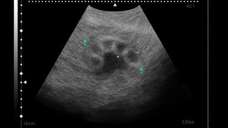 Sonogram of human kidney, illustration. Ultrasound diagnostic