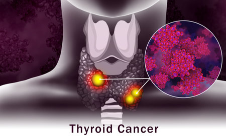 Illustration of human thyroid cancer on color background
