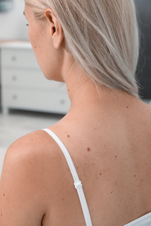 Closeup view of woman`s body with birthmarks indoorsの写真素材