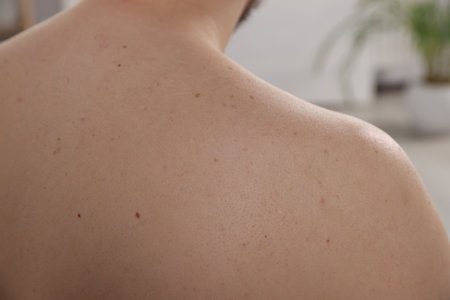 Closeup of man's body with birthmarks on blurred background, back viewの写真素材