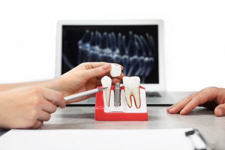 Doctor showing patient educational model of dental implant in clinic, closeupの写真素材