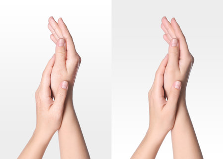 Collage with photos of woman showing hands with dry and moisturized skin on white background, closeupの写真素材