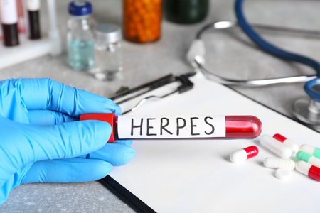 Doctor in glove holding test tube with word Herpes near different pills and clipboard on light gray table, closeupの写真素材