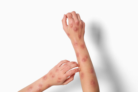 Woman with rash suffering from monkeypox virus on white background, closeup