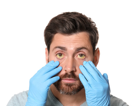 Doctor checking man with yellow eyes on white background. Symptom of hepatitisの写真素材