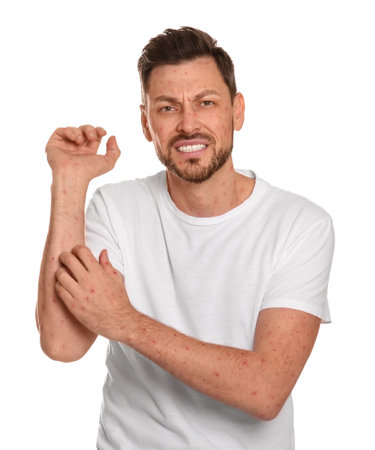 Man with rash suffering from monkeypox virus on white background