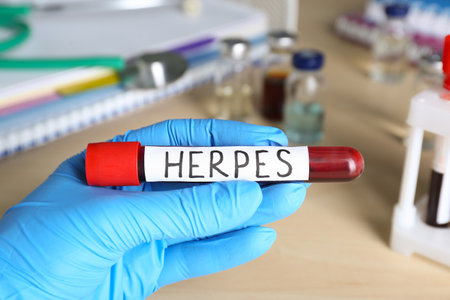 Doctor in glove holding test tube with word Herpes at wooden table, closeup