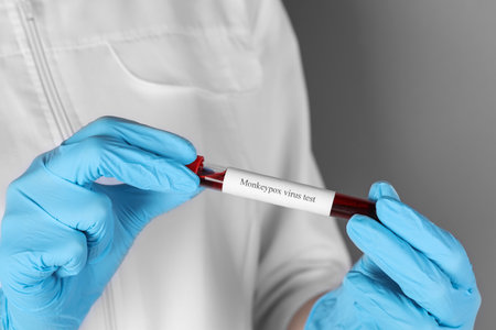 Monkeypox virus diagnosis. Laboratory worker holding test tube with blood sample on gray background, closeupの写真素材