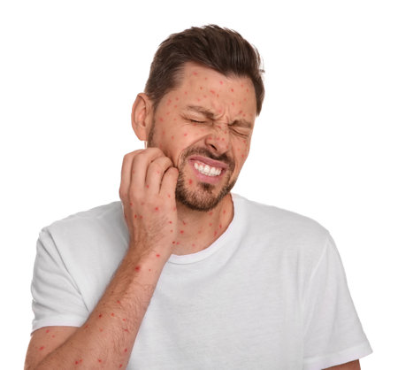 Man with rash suffering from monkeypox virus on white backgroundの写真素材