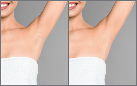 Collage of woman showing armpit before and after epilation on light gray background, closeupの写真素材