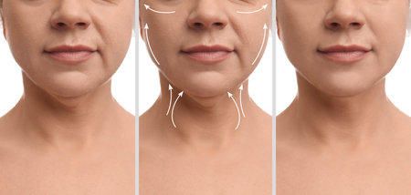 Mature woman before and after plastic surgery operation on white background, closeup. Double chin...