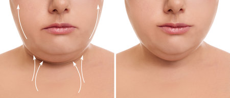 Woman before and after plastic surgery operation on white background, closeup. double chin problem