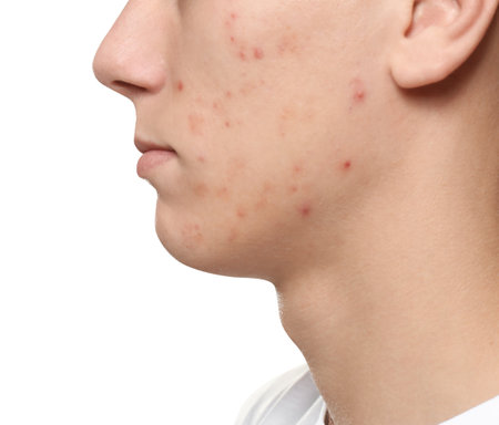 Teen guy with acne problem on white background, closeupの写真素材