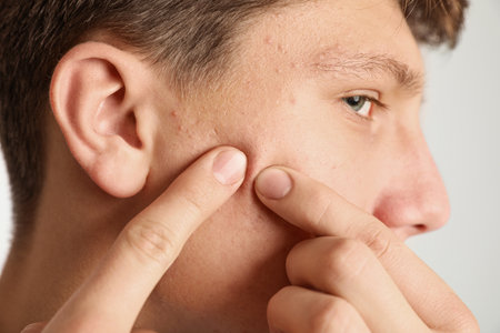 Teen guy with acne problem squeezing pimple on his face on light background, closeupの写真素材