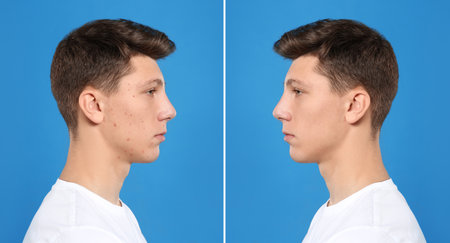 Teenager before and after acne treatment on blue background