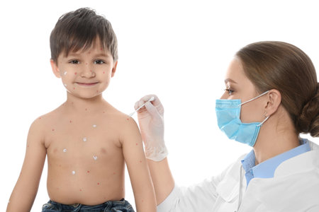 Doctor applying cream onto skin of little boy with chickenpox against white background. Varicella...