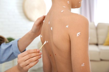 Woman applying cream onto skin of little boy with chickenpox at home, closeupの写真素材