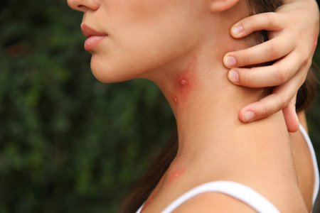 Woman scratching neck with insect bites in park, closeupの写真素材