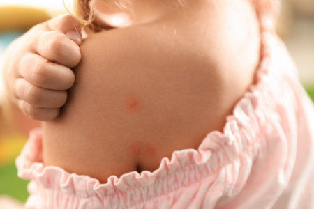 Girl scratching shoulder with insect bite, closeupの写真素材
