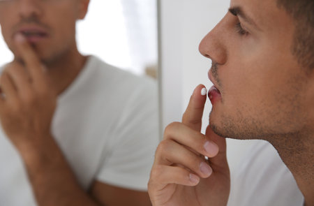 Man with herpes applying cream on lips in front of mirror, closeupの写真素材
