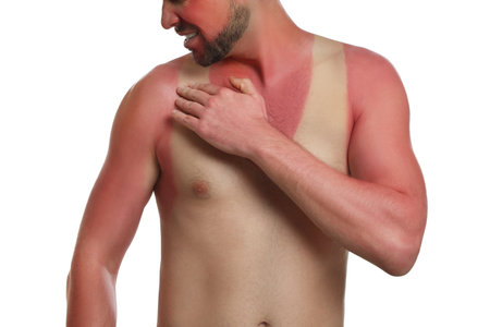 Man with sunburned skin on white background, closeupの写真素材