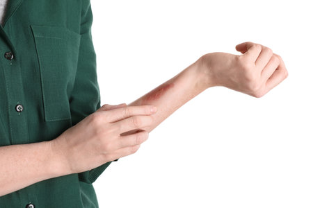 Woman with burned hand on white background, closeupの写真素材