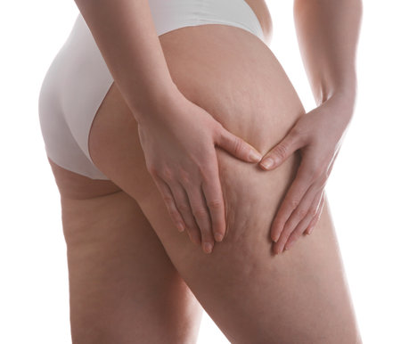 Woman with cellulite on white background, closeupの写真素材