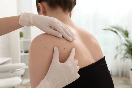Dermatologist examining patient's birthmark in clinic, closeupの写真素材