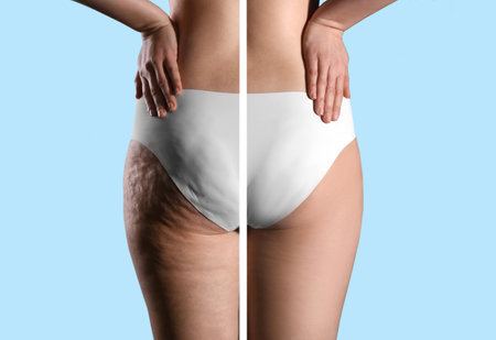 Collage with photos of woman before and after anti cellulite treatment on light blue background,の写真素材