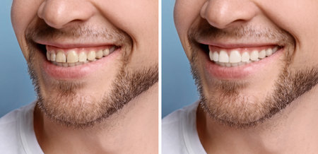 Collage with photos of man before and after teeth whitening, closeup. banner designの写真素材