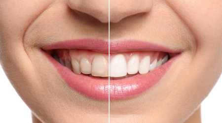Collage with photos of woman before and after teeth whitening, closeup. Banner designの写真素材