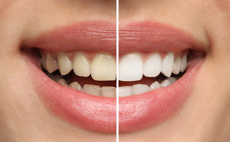 Collage with photos of woman before and after teeth whitening, closeupの写真素材