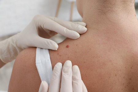 Dermatologist examining patient's birthmark in clinic, closeupの写真素材