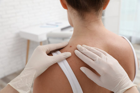 Dermatologist examining patient's birthmark in clinic, closeupの写真素材
