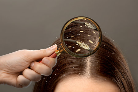 Pediculosis. Woman with lice and nits on gray background, closeup. View through magnifying glass on...