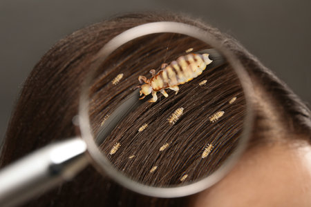 Pediculosis. Woman with lice and nits, closeup. View through magnifying glass on hairの写真素材