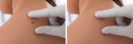 Collage with photos of patient's back before and after mole removing procedure, closeup. Dermatologist checking woman's skinの写真素材