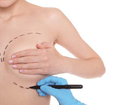Doctor drawing marks on female breast for cosmetic surgery operation against white background, closeupの写真素材