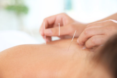 Young woman undergoing acupuncture treatment in salon, closeupの写真素材