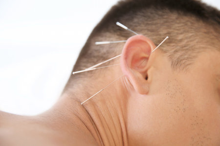 Young man undergoing acupuncture treatment in salon, closeupの写真素材
