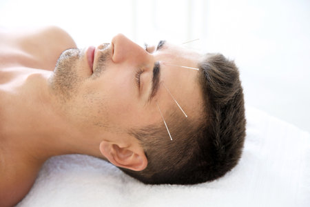 Young man undergoing acupuncture treatment in salonの写真素材