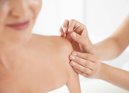 Young woman undergoing acupuncture treatment in salon, closeupの写真素材