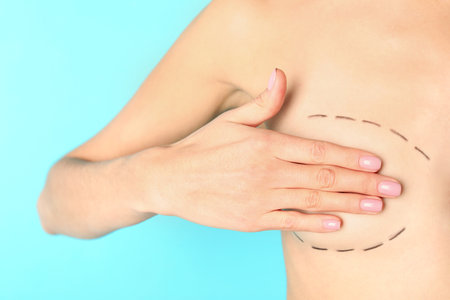 Young woman with marks on breast for cosmetic surgery operation against color background, closeupの写真素材