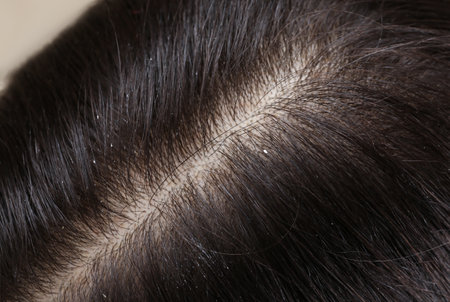 Woman with dandruff in her dark hair, closeup viewの写真素材