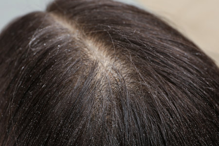 Woman with dandruff in her dark hair, closeup viewの写真素材