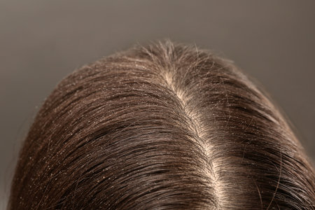 Woman with dandruff in her dark hair on gray background, closeupの写真素材