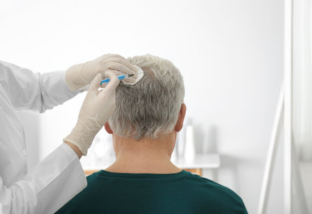 Senior man with hair loss receiving problem injection in salonの写真素材