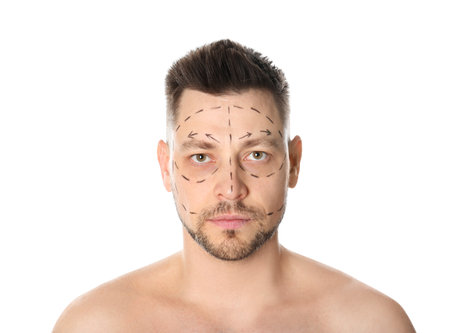 Man with marks on face for cosmetic surgery operation against white backgroundの写真素材